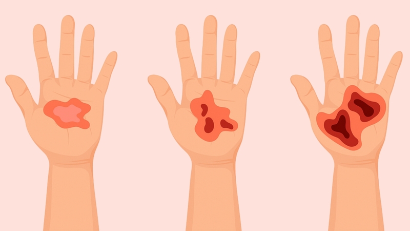 Điều trị vết bỏng cần được thực hiện phù hợp với mức độ tổn thương để đảm bảo an toàn và tối ưu quá trình phục hồi