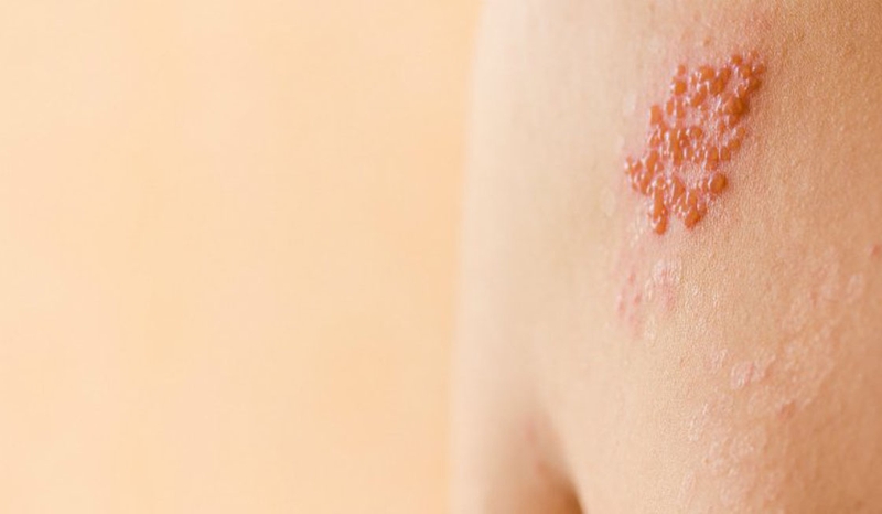 Biểu hiện thường gặp của bệnh giời leo