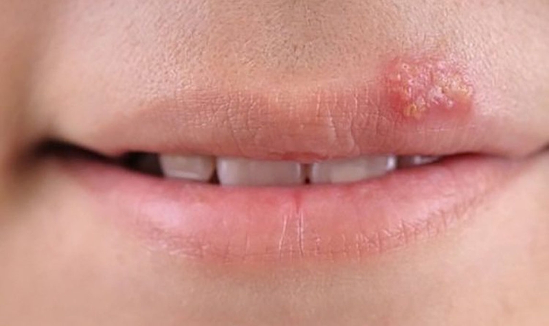 Bôi kem đánh răng trị giời leo