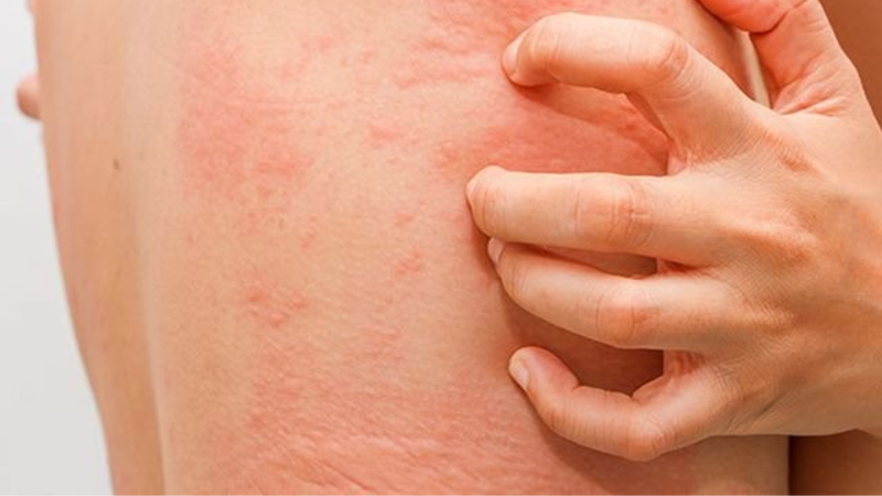 Khi bị sâu lông ngứa phải làm sao? Điều trị sao cho hiệu quả? 1