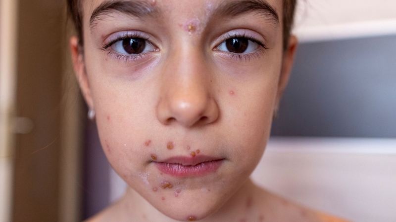 Khi bị thủy đậu có được ăn cà chua không? Nên ăn như thế nào? 1