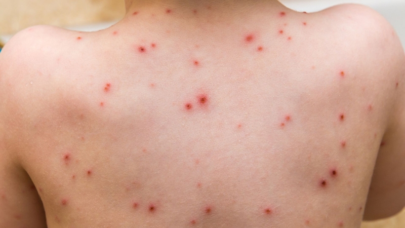Khi bị thủy đậu có được ăn cà chua không? Nên ăn như thế nào? 4
