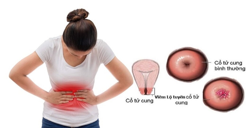 Khi bị trễ kinh đau bụng dưới ra huyết trắng nên làm gì? 2