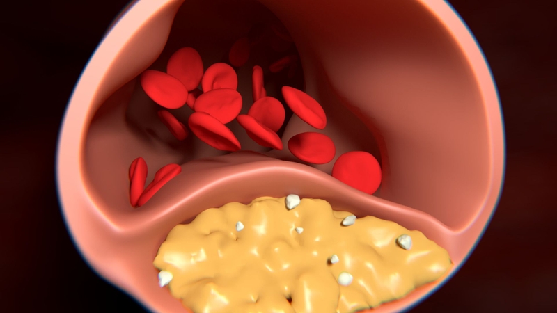 Cholesterol máu tăng cao kéo dài là yếu tố quan trọng thúc đẩy sự hình thành mảng xơ vữa trong thành động mạch