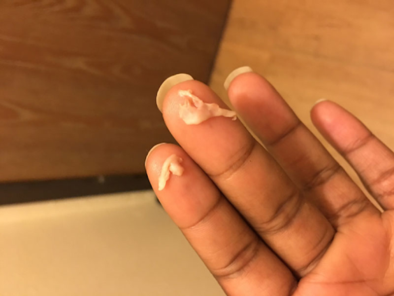 Những biện pháp phòng tránh khí hư bị vón cục