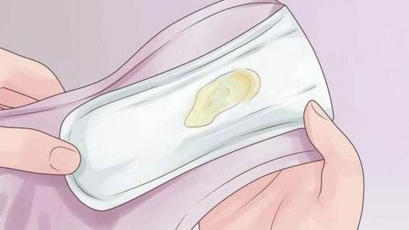 Khí hư màu vàng và có mùi tanh là hiện tượng nhiều chị em phụ nữ gặp phải nhất