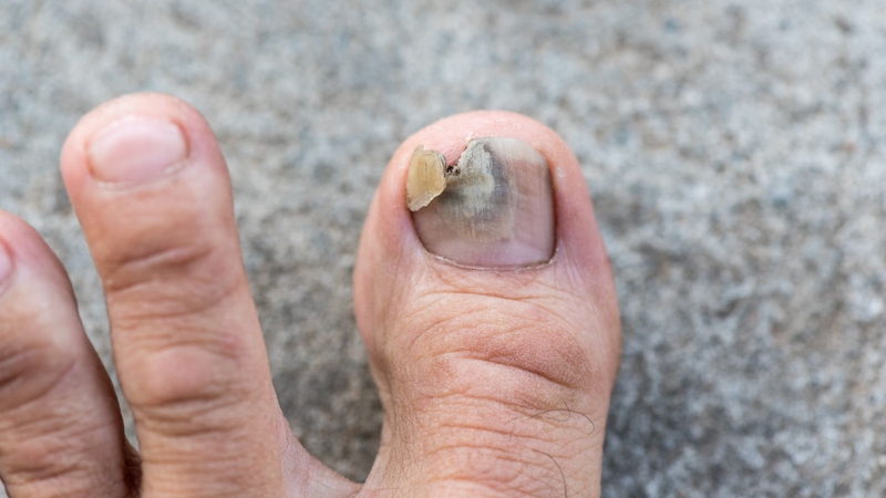 Giày chật, va đập hoặc đè ép lặp lại có thể làm móng bị tổn thương, trở nên yếu và tăng nguy cơ nhiễm trùng, trong đó có nhiễm nấm