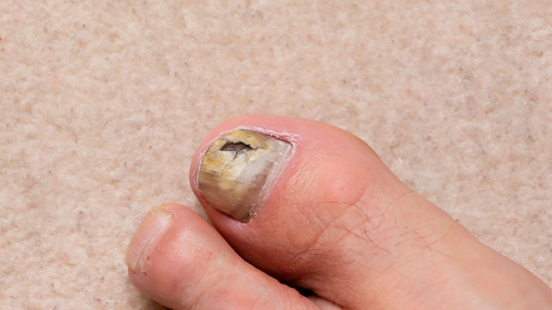 Móng chân bị nấm có mọc lại không còn phải phụ thuộc vào nhiều yếu tố