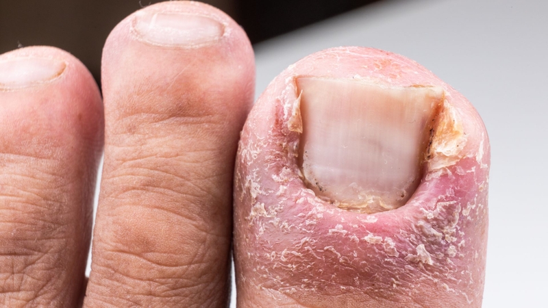 Nên cắt gọn móng và loại bỏ phần móng đã bong khỏi nền móng để giảm môi trường thuận lợi cho nấm phát triển