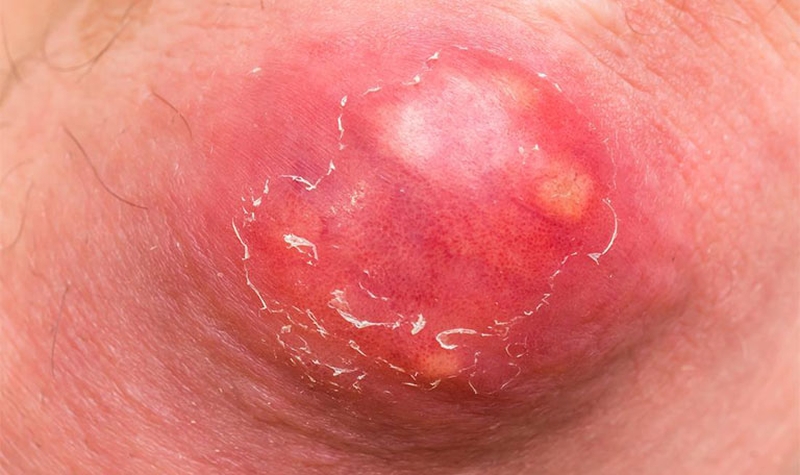 Mụn nhọt là những nốt mụn đỏ, sưng đau