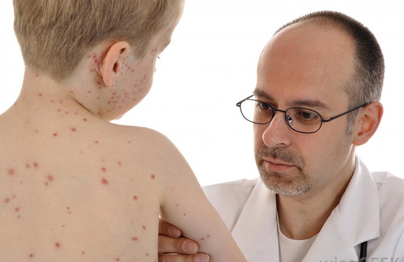 Khi nào bệnh thủy đậu hết lây 3