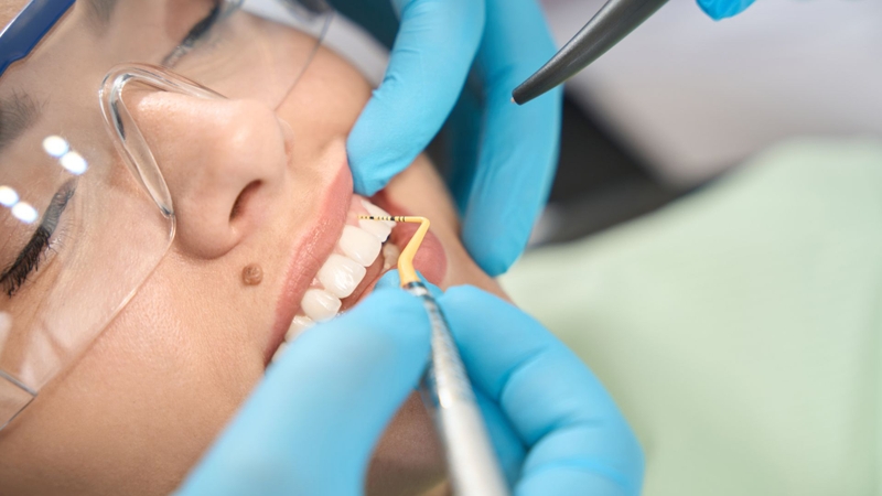 Khi nào cần cắt kẽ răng trong chỉnh nha? Quy trình thực hiện 3