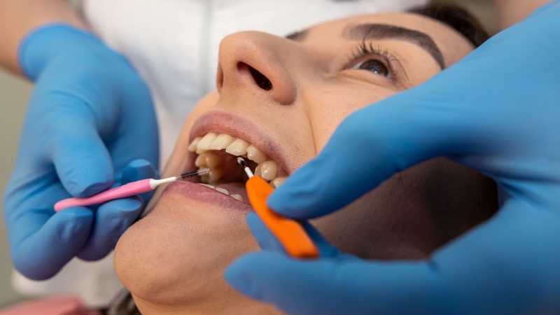 Khi nào cần cắt kẽ răng trong chỉnh nha? Quy trình thực hiện 4