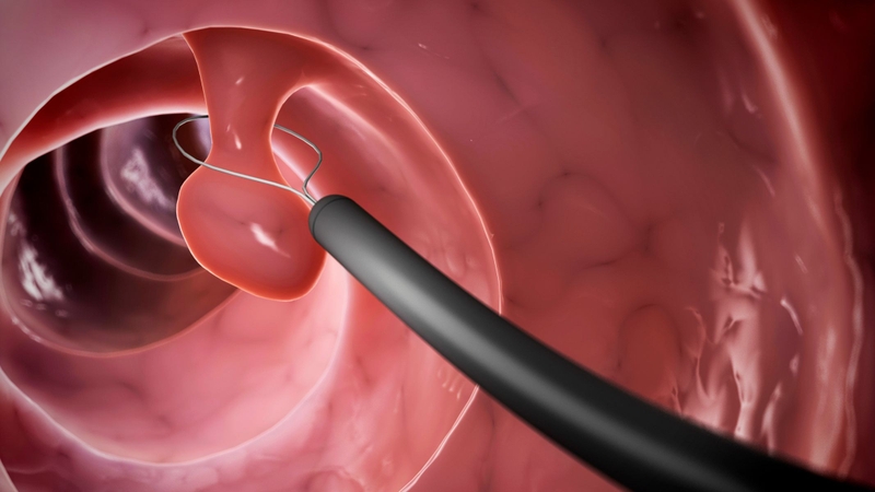 Cắt polyp dạ dày qua nội soi là gì?