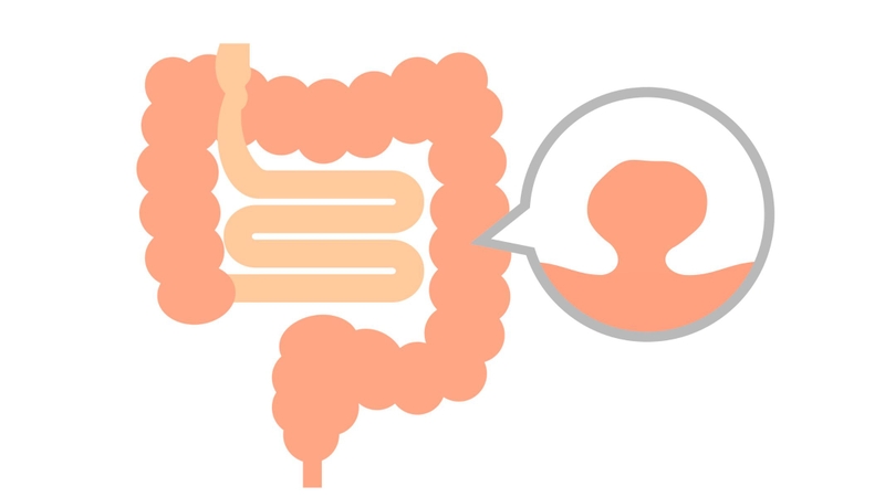 Polyp lớn hơn 1cm, đặc biệt có loét bề mặt, cần cắt bỏ và làm sinh thiết để giảm nguy cơ ung thư