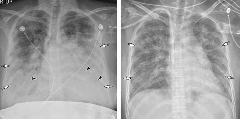 Khi nào cần chụp X quang viêm phổi? Chụp X quang viêm phổi phát hiện bệnh gì? 3