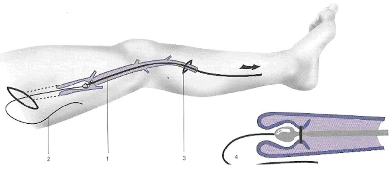 Khi nào cần điều trị suy giãn tĩnh mạch và các phương pháp hiện có? 3