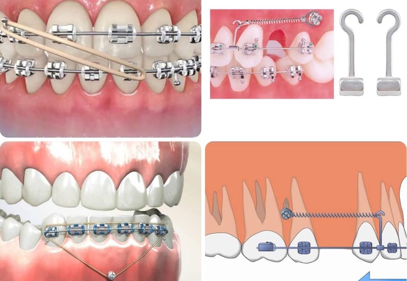 Khi nào cần dùng lò xo niềng răng? Thời gian sử dụng bao lâu? 1