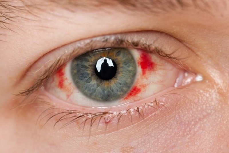 Khi nào cần mổ mắt cận thị? Những điều cần lưu ý trước khi mổ là gì? 3