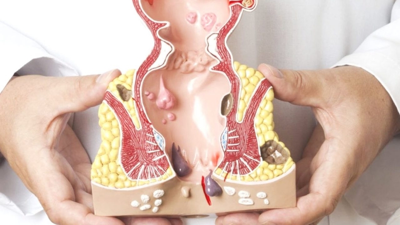 Khi nào cần phẫu thuật cắt trĩ? 1