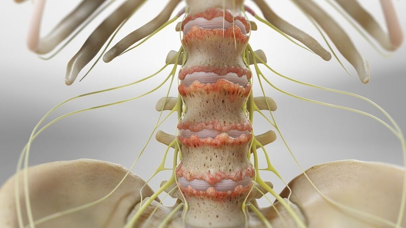 Khi nào cần phẫu thuật viêm cột sống dính khớp? Các phương pháp điều trị khác 1