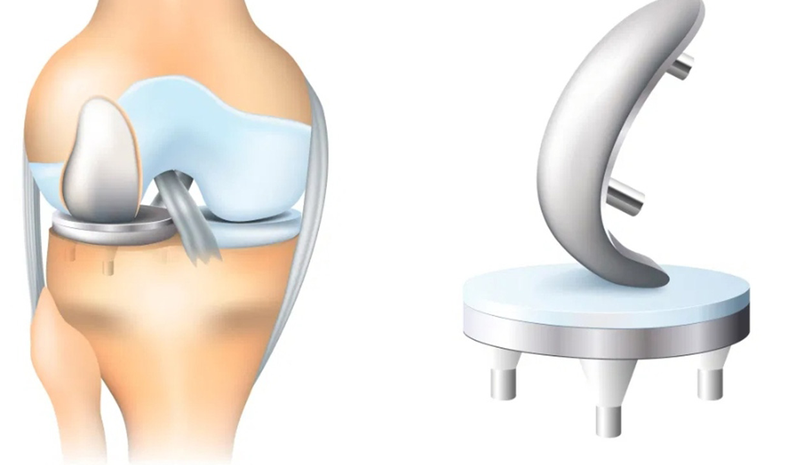 Khi nào cần thực hiện phục hồi chức năng sau thay khớp gối? 1 1