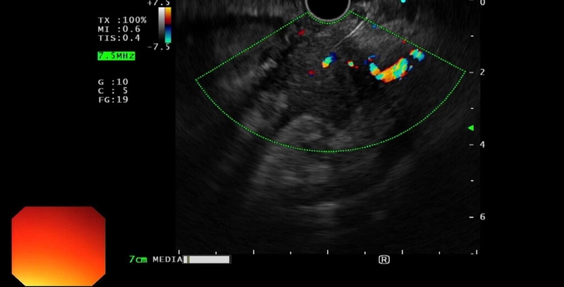 Khi nào cần thực hiện siêu âm tụy? 1