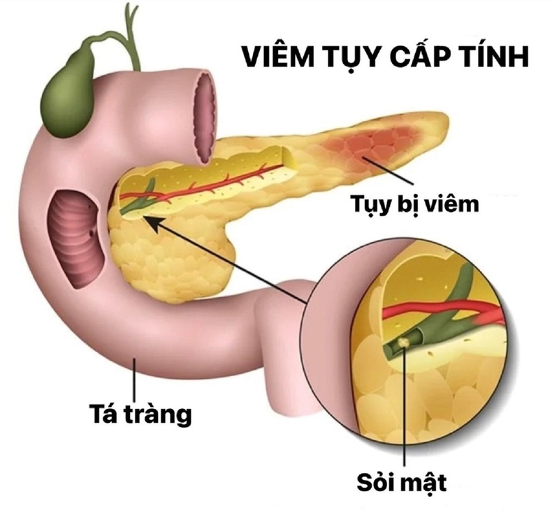 Khi nào cần thực hiện siêu âm tụy? 3