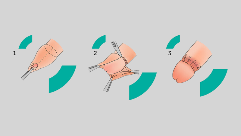 Khi nào cắt bao quy đầu? Không cắt bao quy đầu có sao không? 1