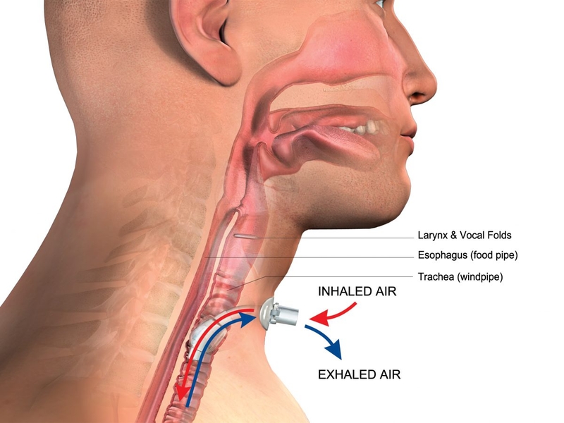 Khi nào mở khí quản cấp cứu được thực hiện? 3