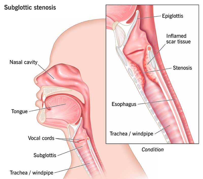 Khi nào mở khí quản cấp cứu được thực hiện? 4