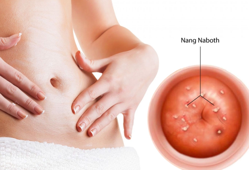 Khi nào nên đốt nang naboth cổ tử cung? Đốt nang naboth cổ tử cung giá bao nhiêu? 1