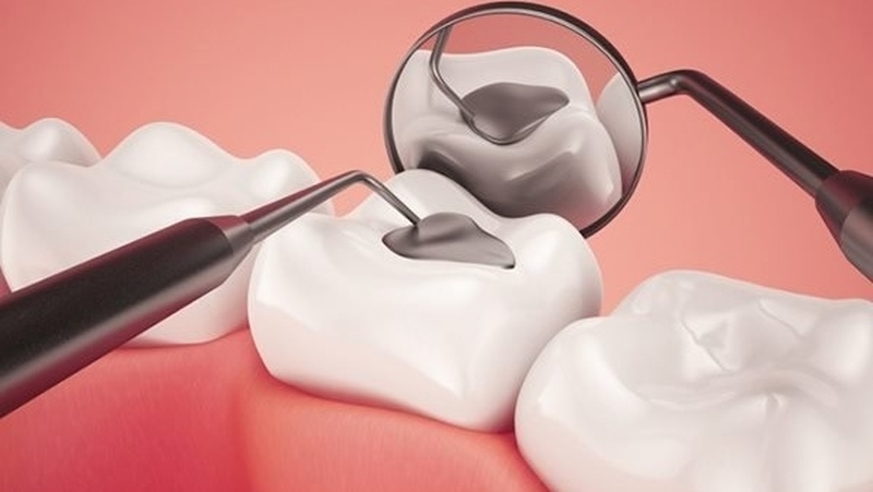 Khi nào nên trám răng? Trám răng có bền không? 3