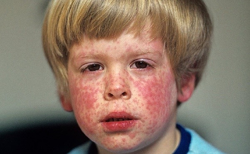 Khi trẻ bị sởi cần làm gì để chăm sóc đúng cách 3