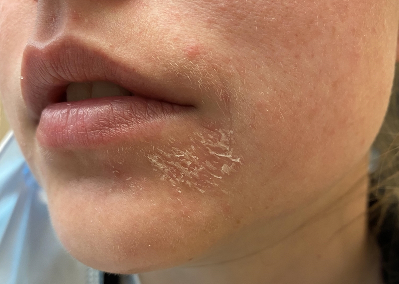 Khô da quanh miệng: Nguyên nhân, triệu chứng, cách khắc phục 1