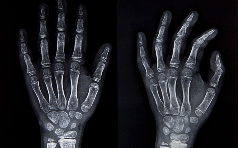 Khô khớp ngón tay: Nguyên nhân, triệu chứng, cách điều trị hiệu quả 3