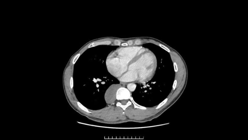 Hình ảnh khối u trung thất sau nằm sát cột sống, gây chèn ép nhiều cấu trúc quan trọng