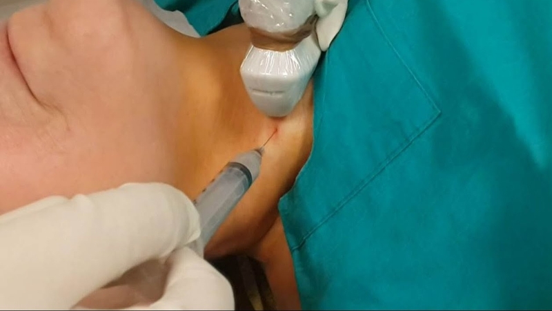 Khoảng cách giữa 2 lần chọc sinh thiết tuyến giáp 3