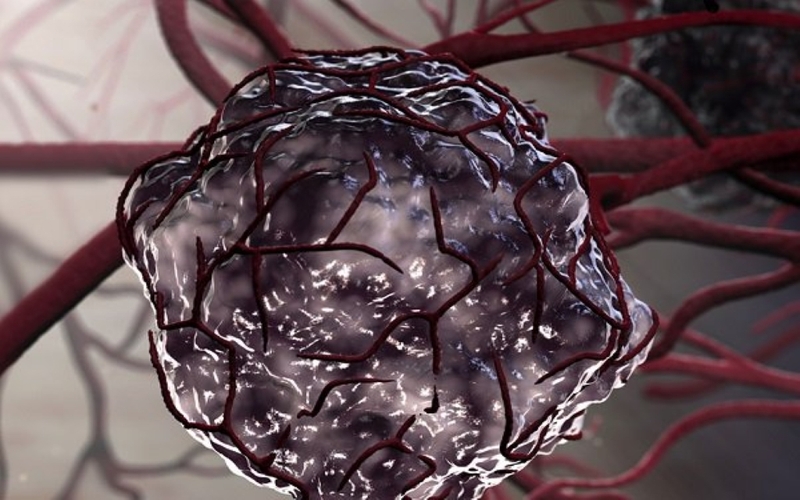 Khối u ác tính có chữa được không? Các phương pháp điều trị khối u ác tính hiện nay 1