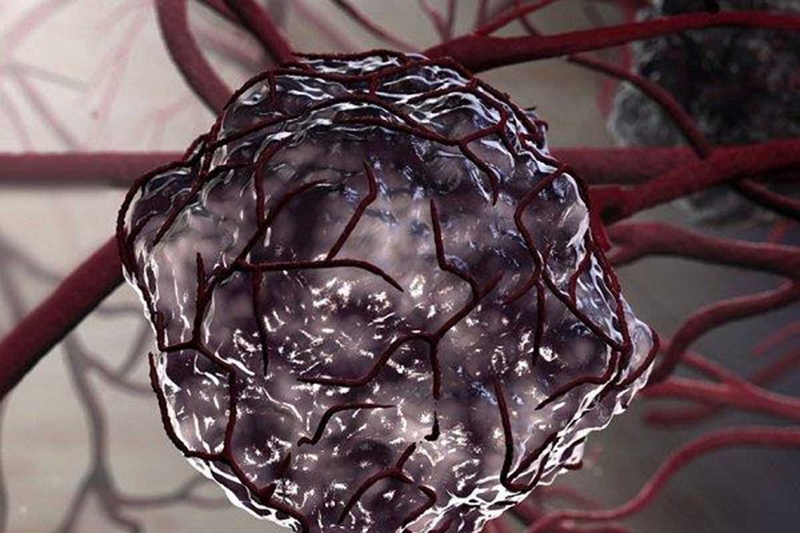 Khối u ác tính là gì? Biểu hiện của khối u ác tính như thế nào? 1