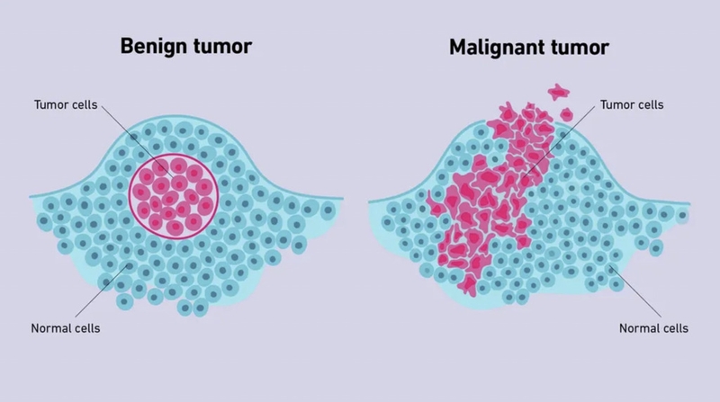 Khối u lành tính có chuyển thành ác tính không? Một số loại u lành tính thường gặp 1