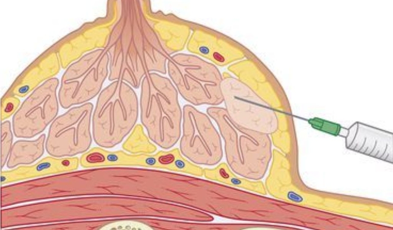 Khối u lành tính thường gặp là gì? U lành tính có nguy hiểm không? 4
