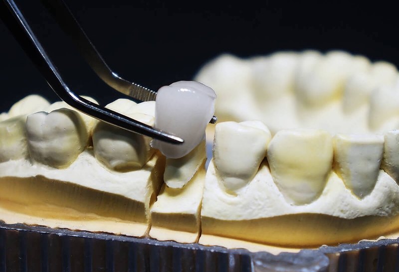 Trường hợp nào nên tháo răng sứ? Tháo răng sứ có đau không? 2