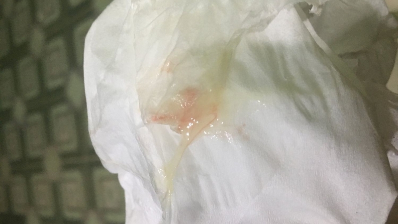 Không chủ quan khi thấy bị ra khí hư lẫn máu 1