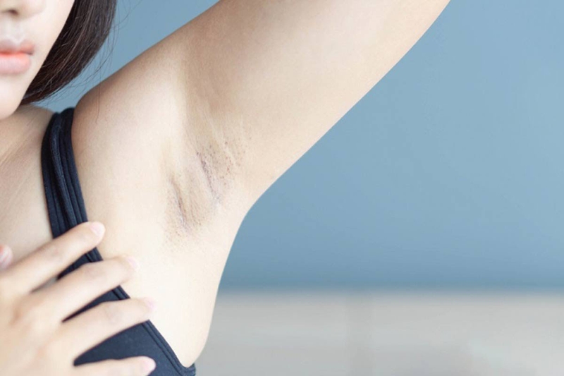 Không có lông nách liệu có đáng lo?