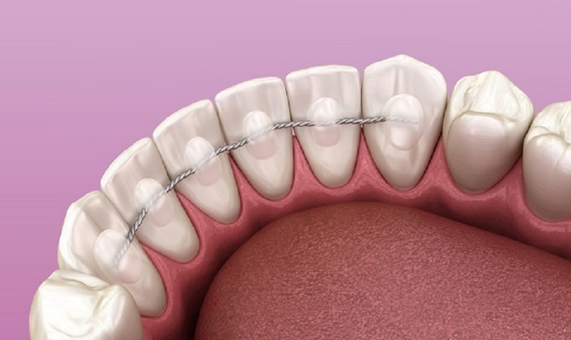 Không đeo hàm duy trì sau niềng răng có ảnh hưởng gì không? 1