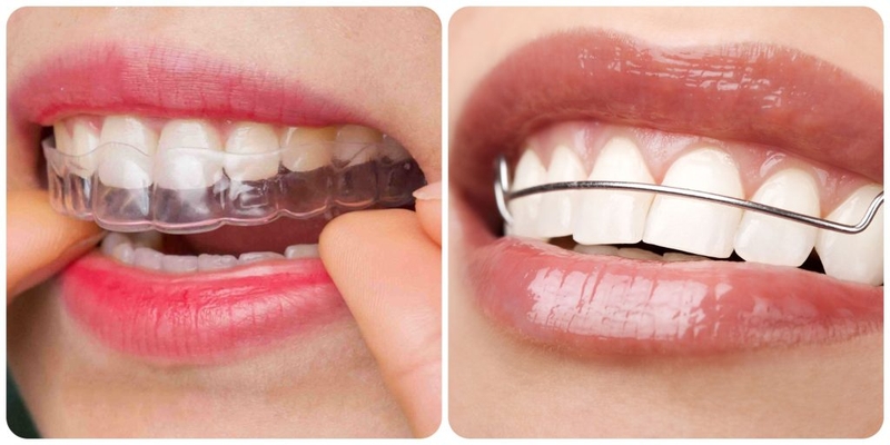 Không đeo hàm duy trì sau niềng răng có ảnh hưởng gì không? 2