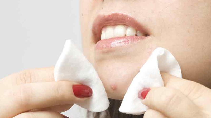 Không nặn mụn có bị rỗ không? Nhiều trường hợp không nặn mụn nhưng vẫn hình thành sẹo rỗ trên mặt