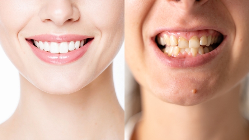 Khớp cắn chuẩn giúp răng ăn khớp hài hòa, trong khi khớp cắn sai lệch gây mất cân đối chức năng và thẩm mỹ