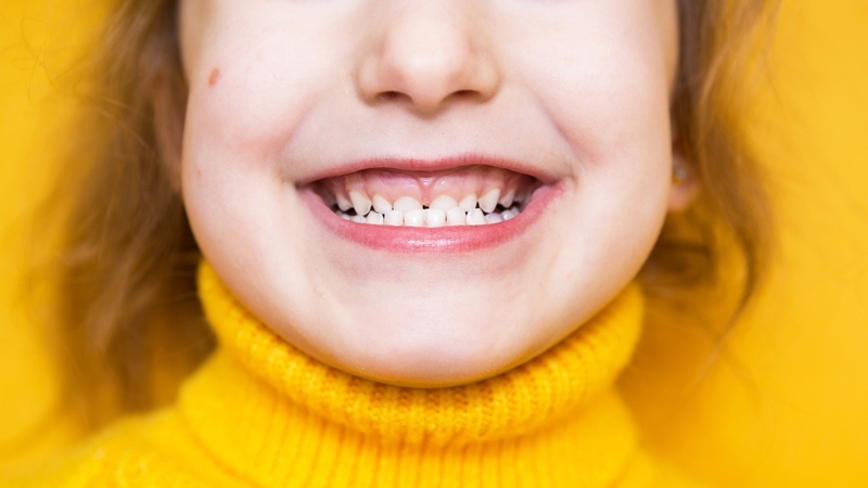 Khớp cắn ngược là tình trạng răng hoặc hàm dưới đưa ra trước so với răng hoặc hàm trên, khiến khớp cắn bị đảo ngược